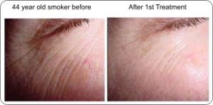 light_smoker skin before and after pic