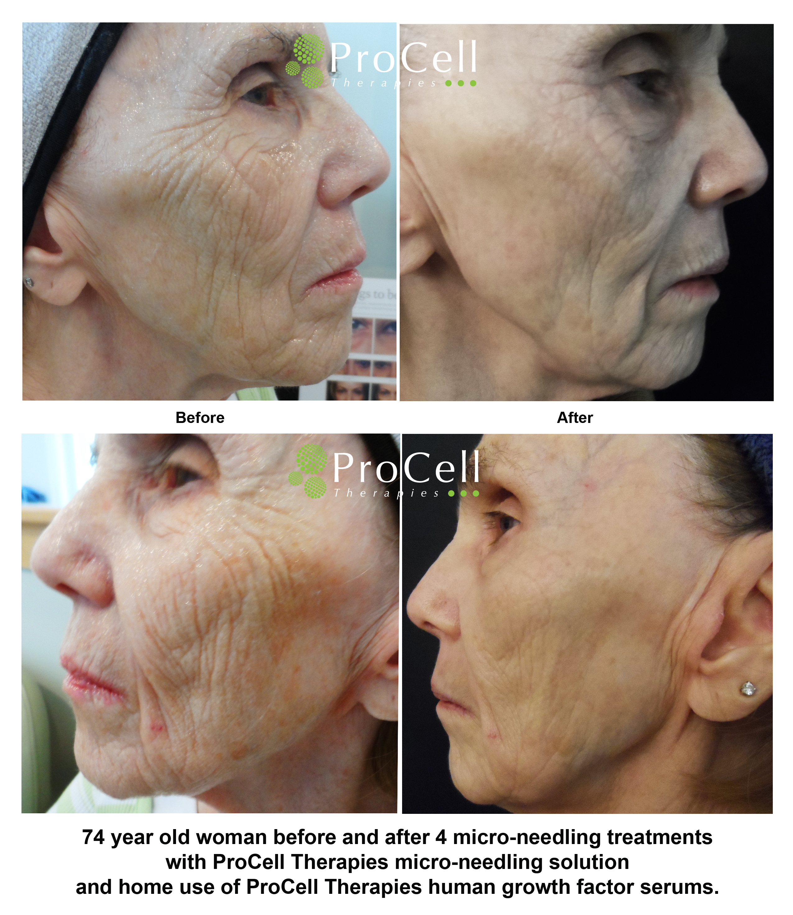 procell-before-and-after-2.jpg?w\u003d25